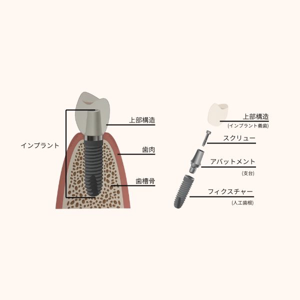 インプラント図解イメージ